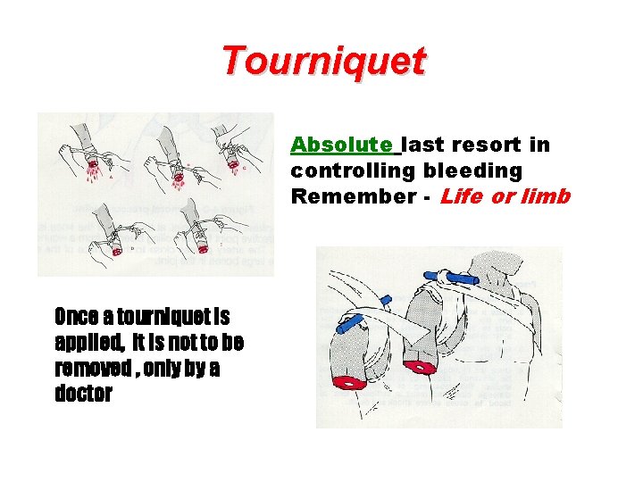 Tourniquet Absolute last resort in controlling bleeding Remember - Life or limb Once a Tourniquet Absolute last resort in controlling bleeding Remember - Life or limb Once a