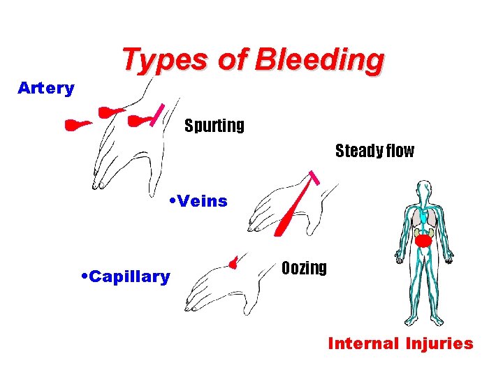 Artery Types of Bleeding Spurting Steady flow • Veins • Capillary Oozing Internal Injuries Artery Types of Bleeding Spurting Steady flow • Veins • Capillary Oozing Internal Injuries