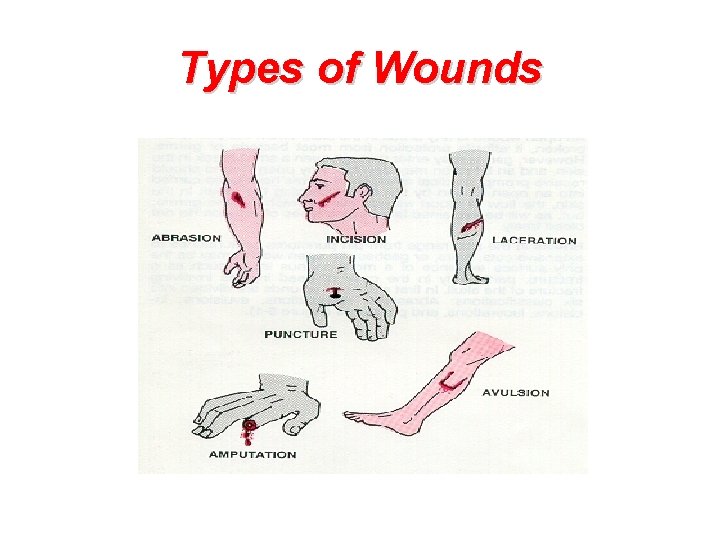 Types of Wounds  Types of Wounds