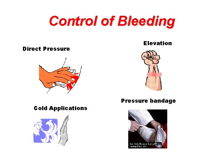Control of Bleeding Direct Pressure Cold Applications Elevation Pressure bandage  Control of Bleeding Direct Pressure Cold Applications Elevation Pressure bandage
