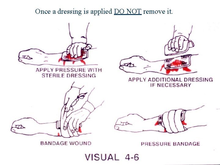 Once a dressing is applied DO NOT remove it.  Once a dressing is applied DO NOT remove it.