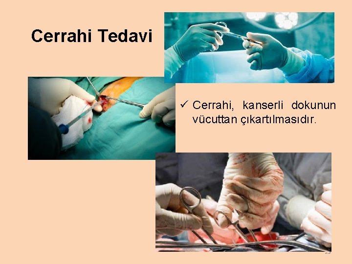 Cerrahi Tedavi ü Cerrahi, kanserli dokunun vücuttan çıkartılmasıdır. 25 