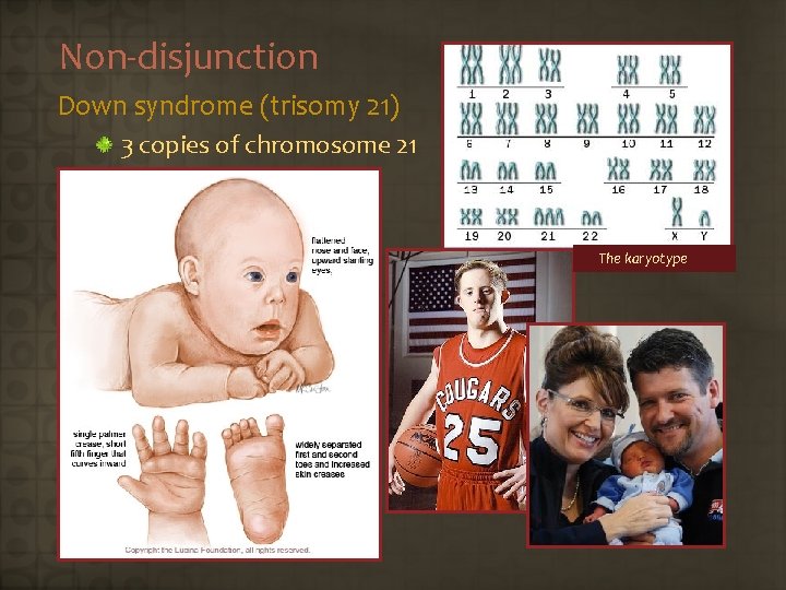 Non-disjunction Down syndrome (trisomy 21) 3 copies of chromosome 21 The karyotype 