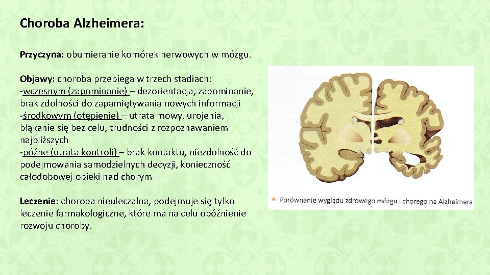 Choroba Alzheimera: Przyczyna: obumieranie komórek nerwowych w mózgu. Objawy: choroba przebiega w trzech stadiach: