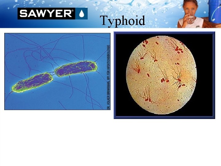 Typhoid 