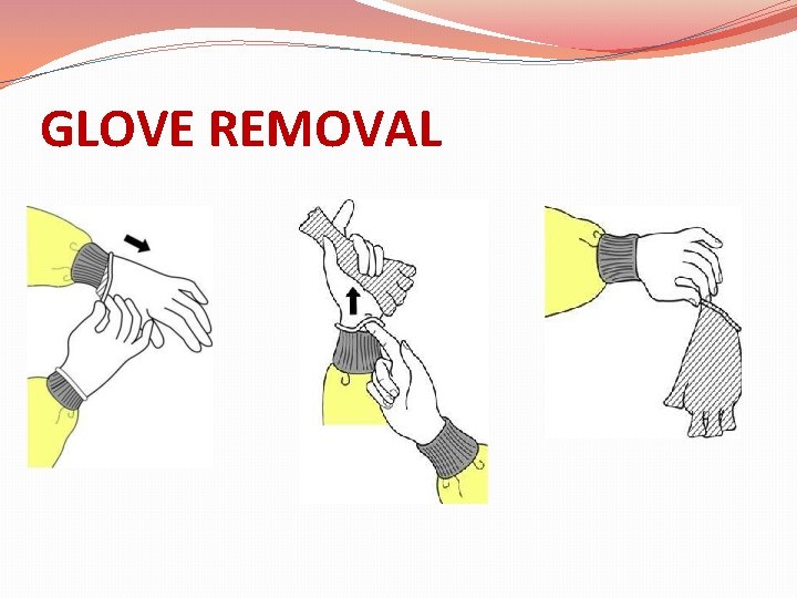 GLOVE REMOVAL 