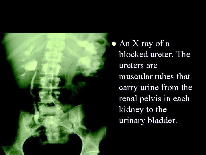 l An X ray of a blocked ureter. The ureters are muscular tubes that