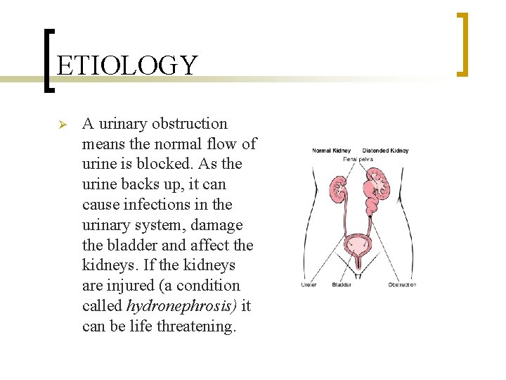 ETIOLOGY Ø A urinary obstruction means the normal flow of urine is blocked. As