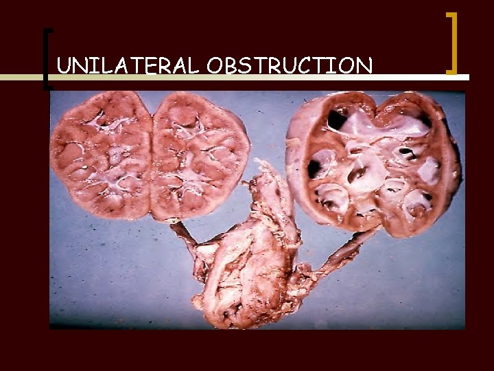 UNILATERAL OBSTRUCTION 