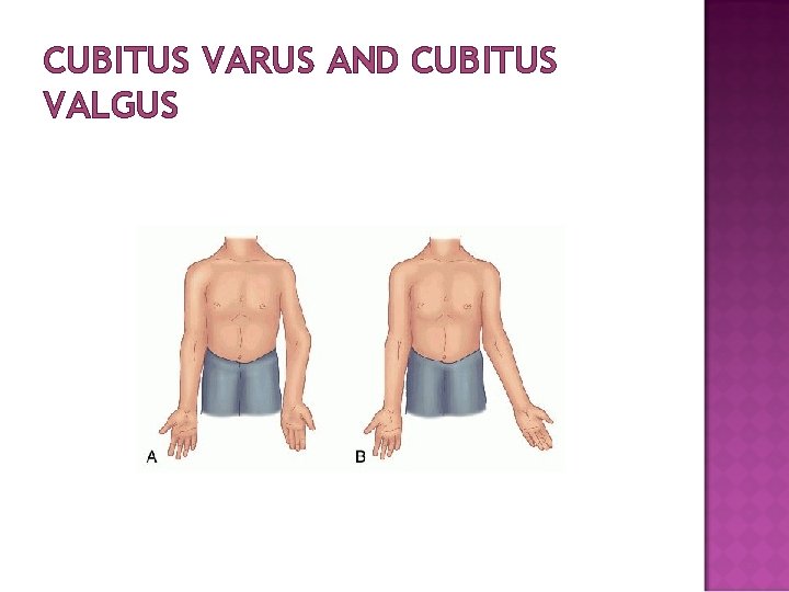 CUBITUS VARUS AND CUBITUS VALGUS 