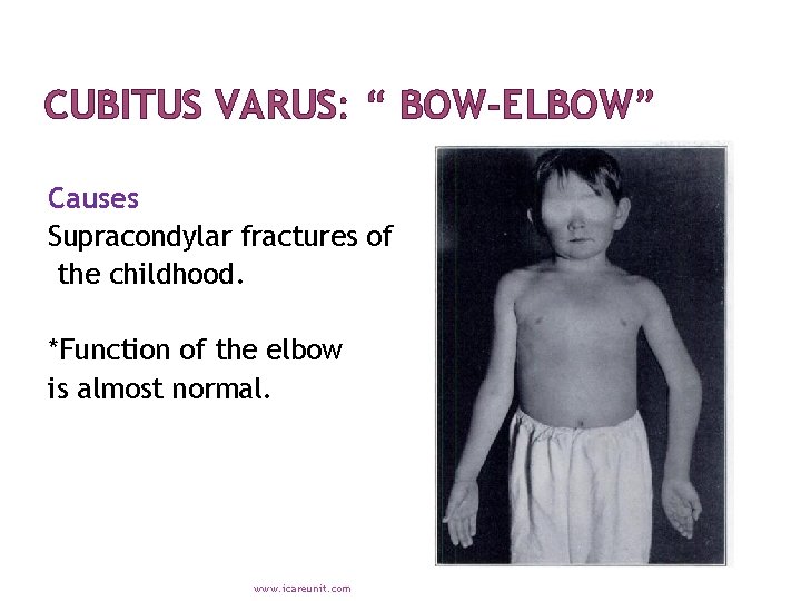 CUBITUS VARUS: “ BOW-ELBOW” Causes Supracondylar fractures of the childhood. *Function of the elbow