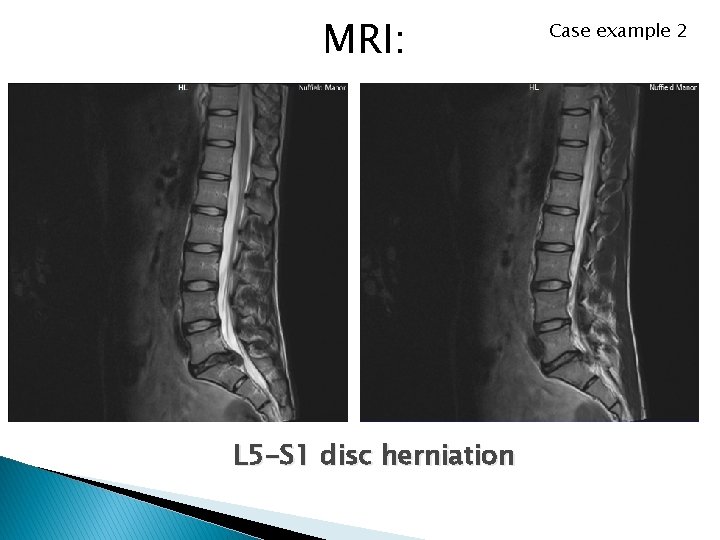 MRI: L 5 -S 1 disc herniation Case example 2 