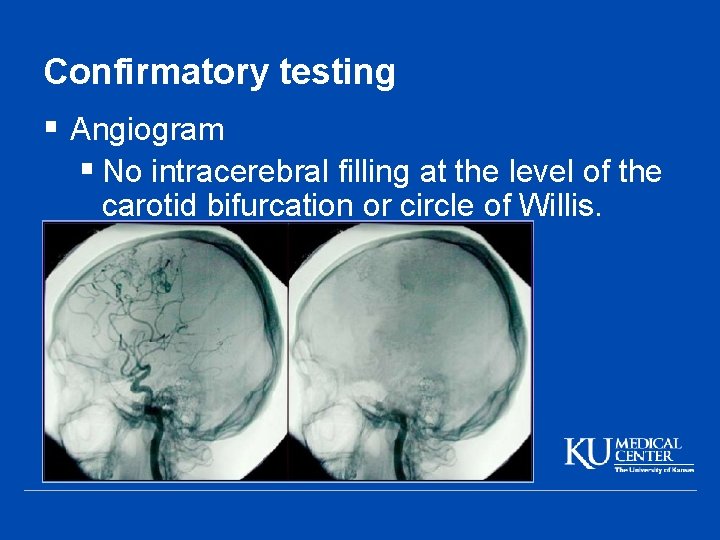 Confirmatory testing § Angiogram § No intracerebral filling at the level of the carotid