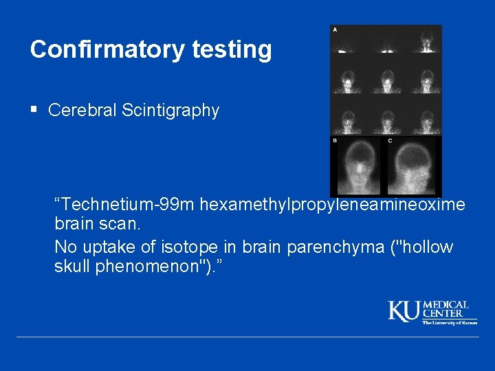 Confirmatory testing § Cerebral Scintigraphy “Technetium-99 m hexamethylpropyleneamineoxime brain scan. No uptake of isotope