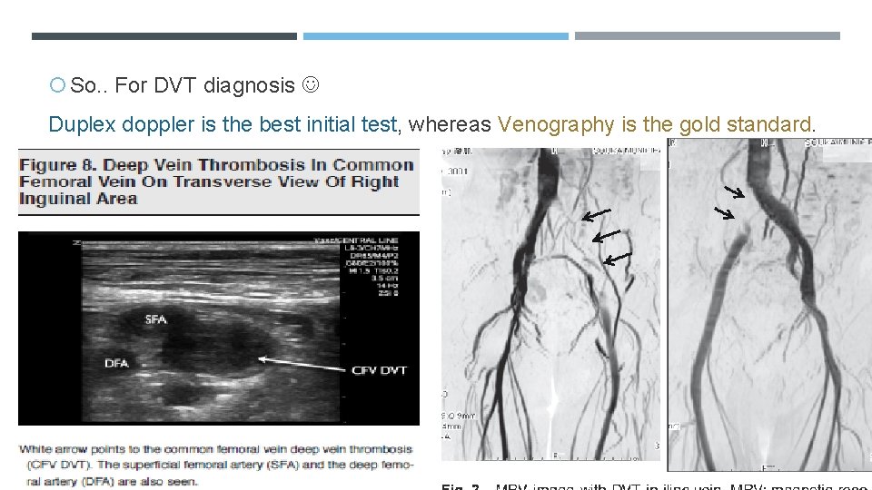  So. . For DVT diagnosis Duplex doppler is the best initial test, whereas