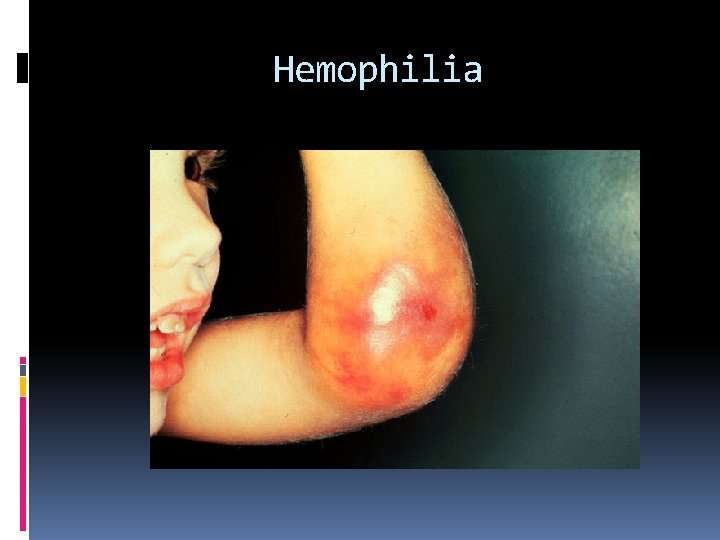 Hemophilia 