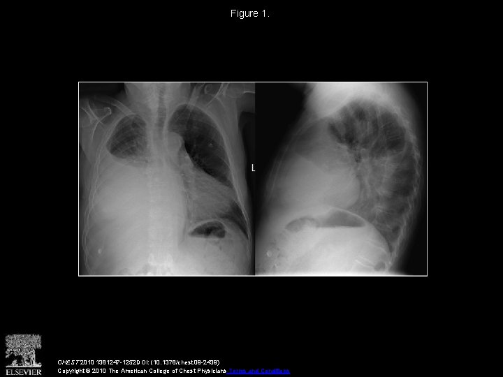 Figure 1. CHEST 2010 1381247 -1252 DOI: (10. 1378/chest. 09 -2439) Copyright © 2010