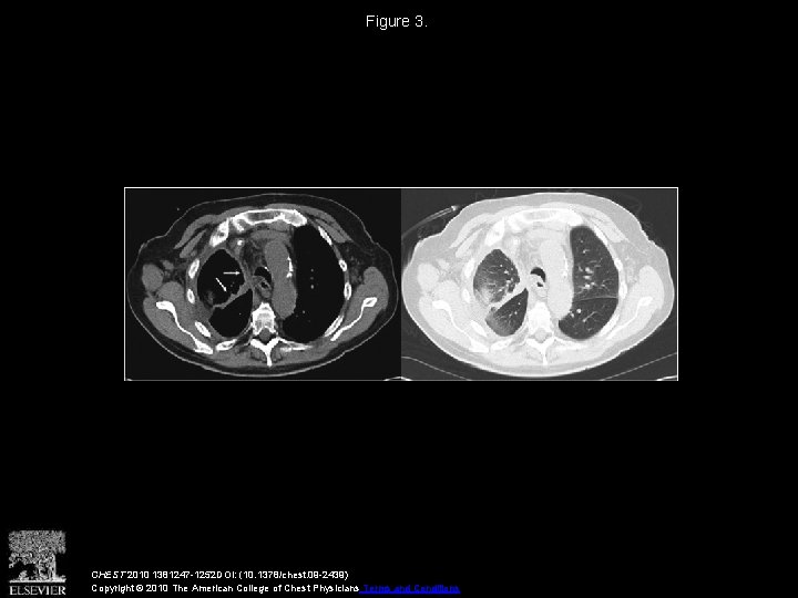 Figure 3. CHEST 2010 1381247 -1252 DOI: (10. 1378/chest. 09 -2439) Copyright © 2010