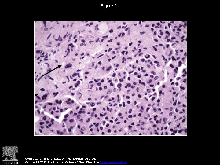 Figure 5. CHEST 2010 1381247 -1252 DOI: (10. 1378/chest. 09 -2439) Copyright © 2010