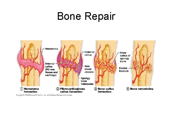 Bone Repair  Bone Repair