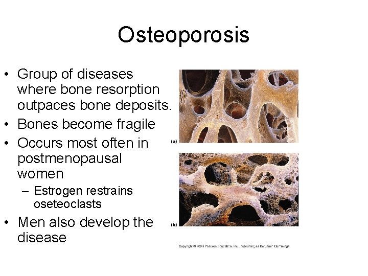 Osteoporosis • Group of diseases where bone resorption outpaces bone deposits. • Bones become Osteoporosis • Group of diseases where bone resorption outpaces bone deposits. • Bones become