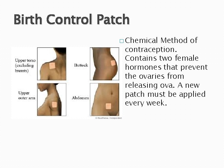 Birth Control Patch � Chemical Method of contraception. Contains two female hormones that prevent