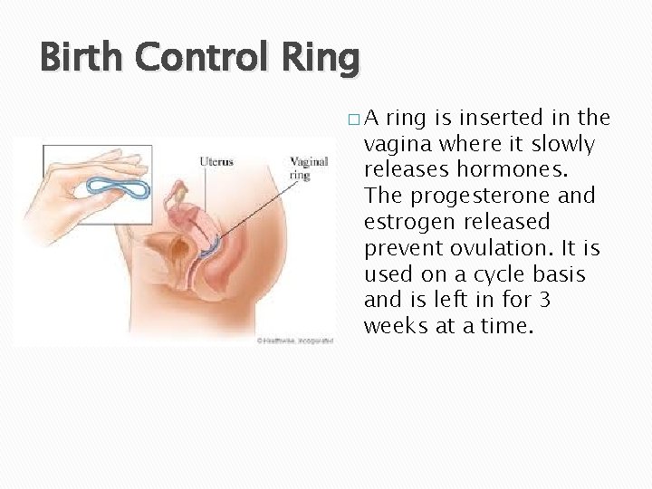 Birth Control Ring �A ring is inserted in the vagina where it slowly releases
