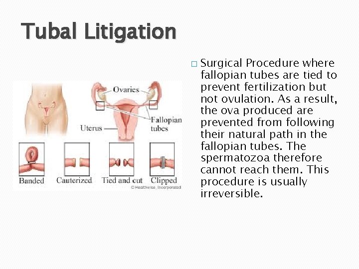Tubal Litigation � Surgical Procedure where fallopian tubes are tied to prevent fertilization but
