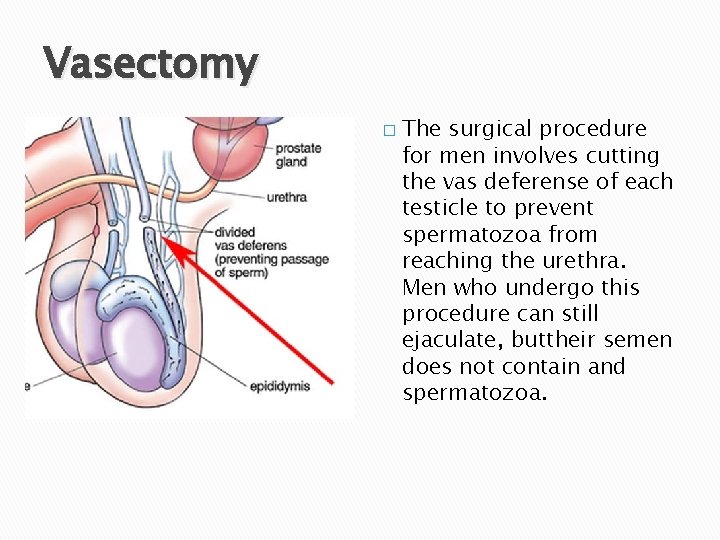 Vasectomy � The surgical procedure for men involves cutting the vas deferense of each