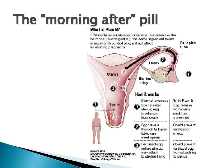 The “morning after” pill 