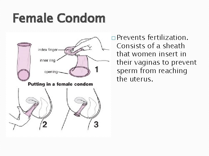 Female Condom � Prevents fertilization. Consists of a sheath that women insert in their