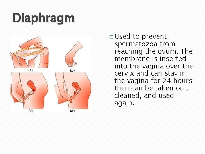 Diaphragm � Used to prevent spermatozoa from reaching the ovum. The membrane is inserted