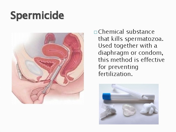 Spermicide � Chemical substance that kills spermatozoa. Used together with a diaphragm or condom,