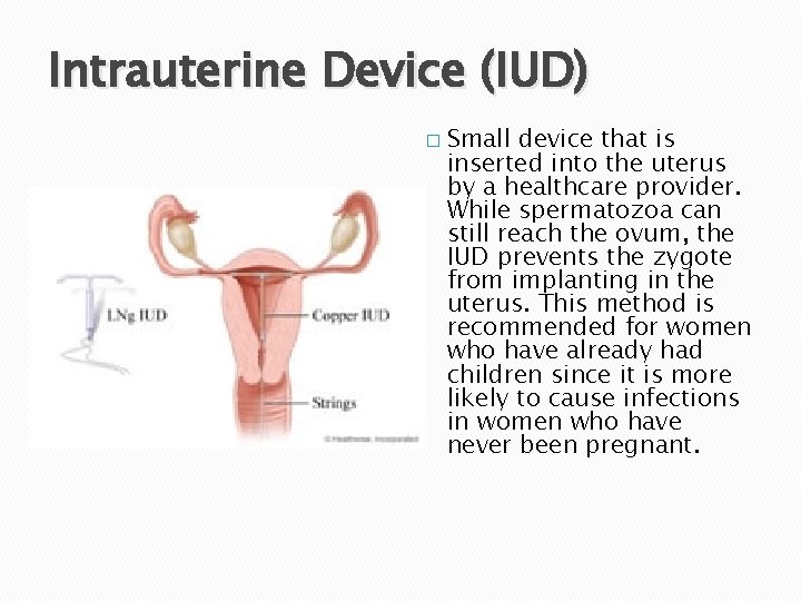 Intrauterine Device (IUD) � Small device that is inserted into the uterus by a