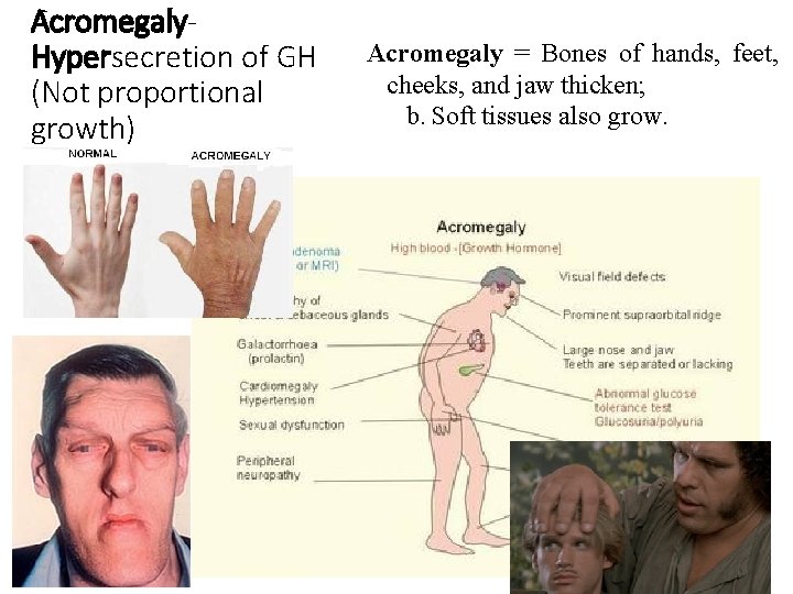 Acromegaly. Hypersecretion of GH (Not proportional growth) Acromegaly = Bones of hands, feet, cheeks,