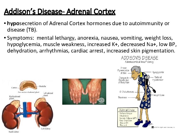 Addison’s Disease- Adrenal Cortex • hyposecretion of Adrenal Cortex hormones due to autoimmunity or