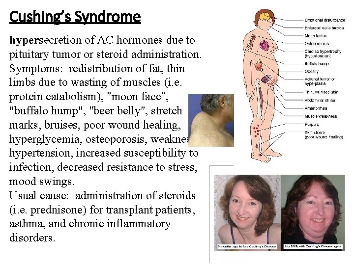 Cushing’s Syndrome hypersecretion of AC hormones due to pituitary tumor or steroid administration. Symptoms: