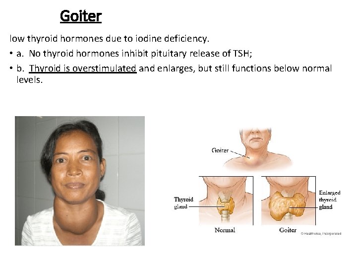 Goiter low thyroid hormones due to iodine deficiency. • a. No thyroid hormones inhibit
