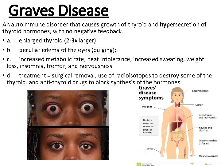 Graves Disease An autoimmune disorder that causes growth of thyroid and hypersecretion of thyroid