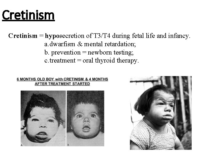 Cretinism = hyposecretion of T 3/T 4 during fetal life and infancy. a. dwarfism