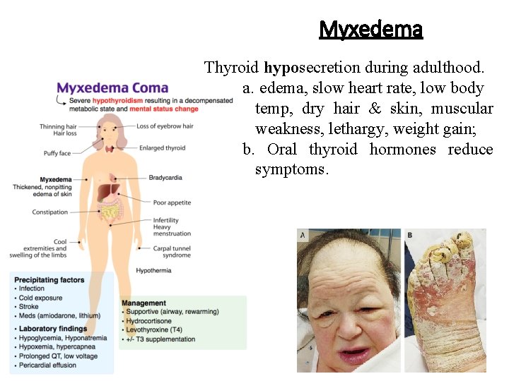 Myxedema Thyroid hyposecretion during adulthood. a. edema, slow heart rate, low body temp, dry