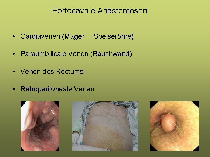Portocavale Anastomosen • Cardiavenen (Magen – Speiseröhre) • Paraumbilicale Venen (Bauchwand) • Venen des