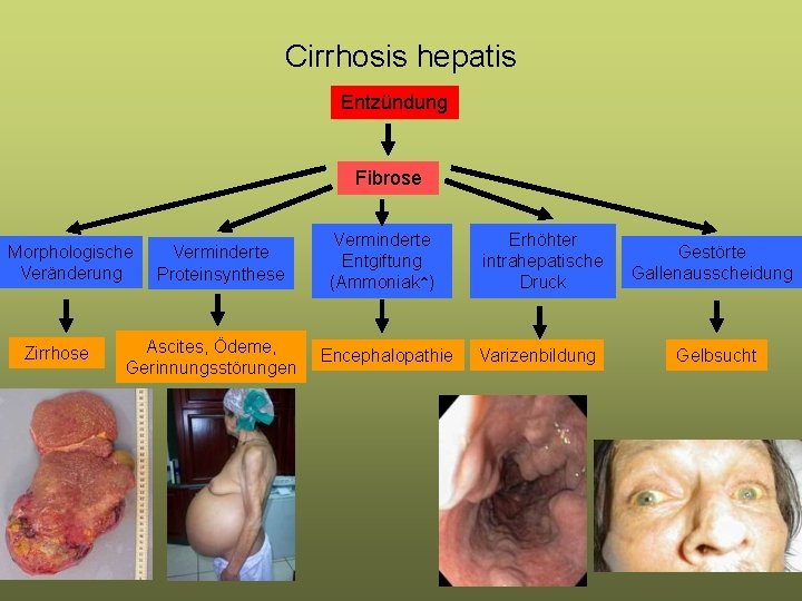 Cirrhosis hepatis Entzündung Fibrose Morphologische Veränderung Zirrhose Verminderte Proteinsynthese Ascites, Ödeme, Gerinnungsstörungen Verminderte Entgiftung