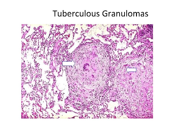 Tuberculous Granulomas 