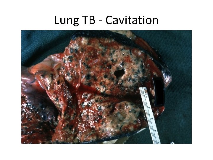 Lung TB - Cavitation 