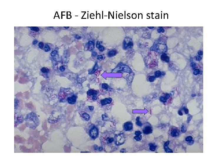 AFB - Ziehl-Nielson stain 
