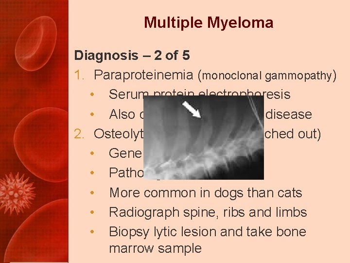 Multiple Myeloma Diagnosis – 2 of 5 1. Paraproteinemia (monoclonal gammopathy) • Serum protein