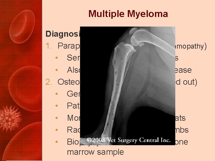 Multiple Myeloma Diagnosis – 2 of 5 1. Paraproteinemia (monoclonal gammopathy) • Serum protein