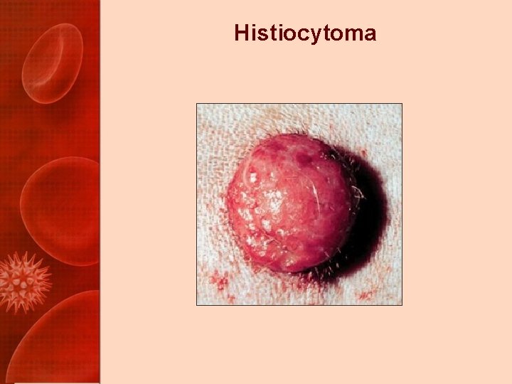 Histiocytoma 