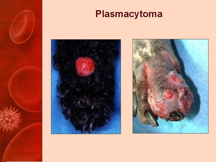 Plasmacytoma 